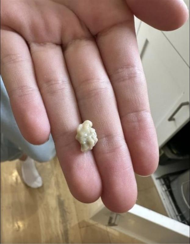 A Clear and Easy Guide to Understanding Tonsil Stones