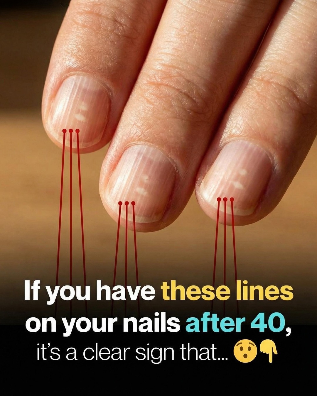 Vertical Nail Ridges: A Common Change as Nails Age