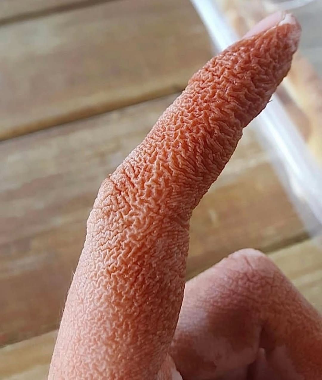 Clinical Features and Management of Sweet Syndrome: A Case Report