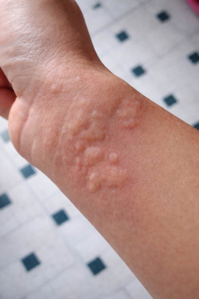 Skin Reactions and Breathing Symptoms: When an Allergy Becomes an Emergency