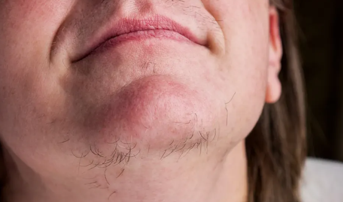 Understanding Chin Hair Growth in Women and What It Can Indicate