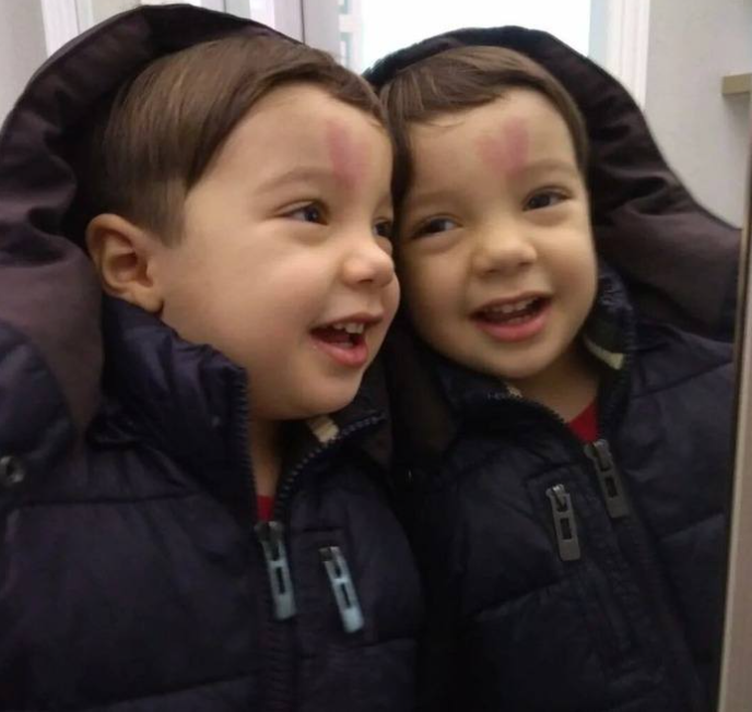 From Viral Newborn to Growing Child: A Birthmark Journey