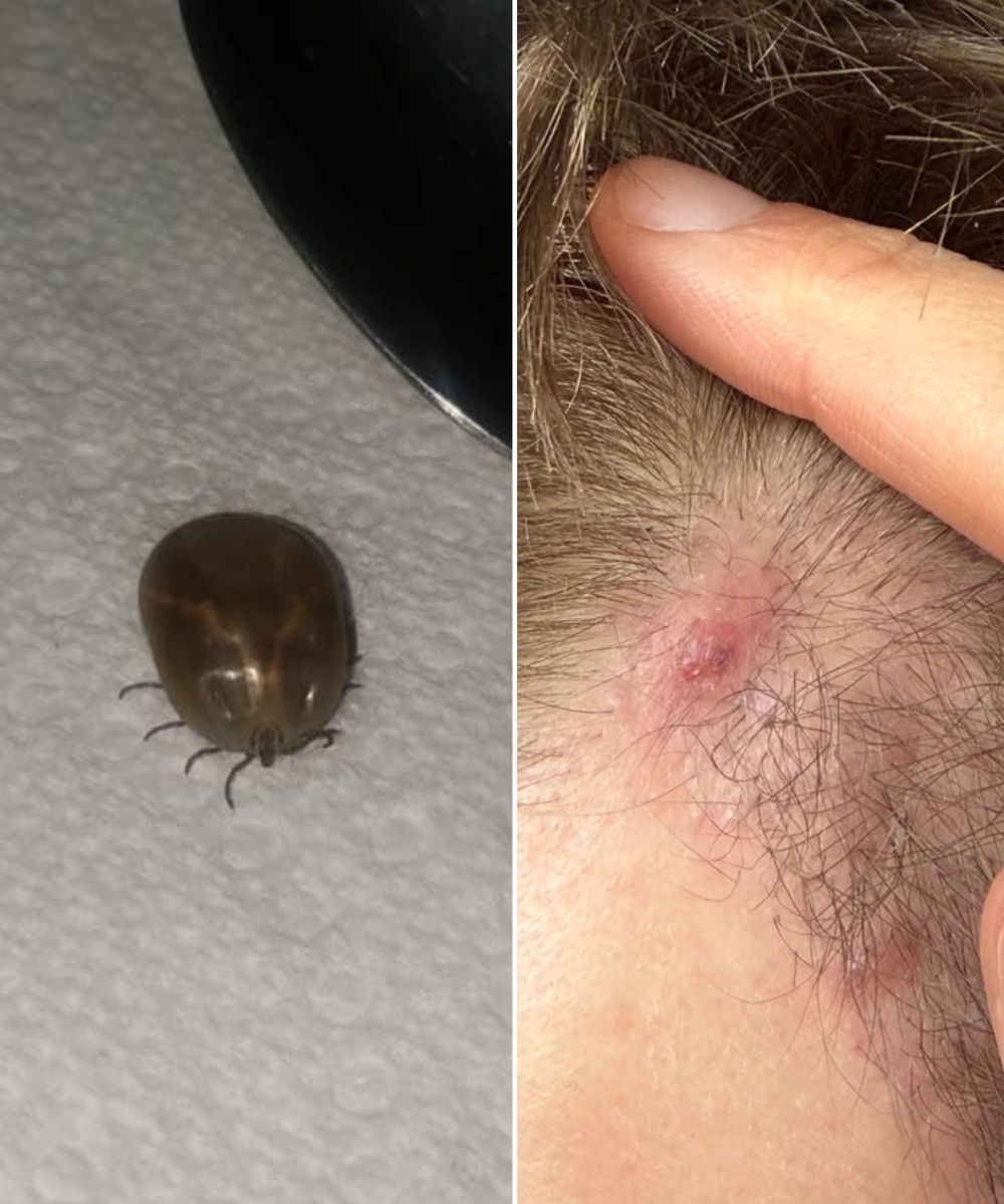 Understanding Tick Bites: Symptoms, Prevention, and Safety Tips