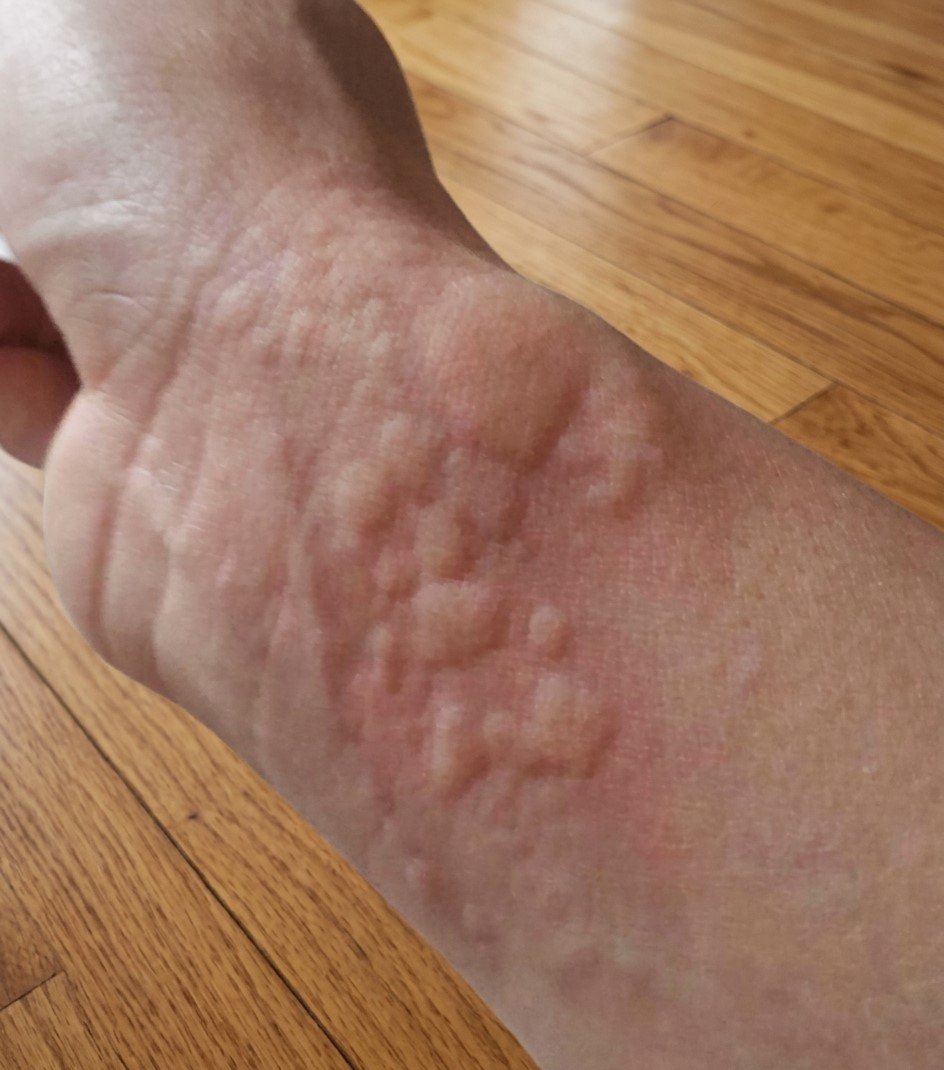 Understanding Serious Rash Symptoms: Important Signs That May Require Medical Attention