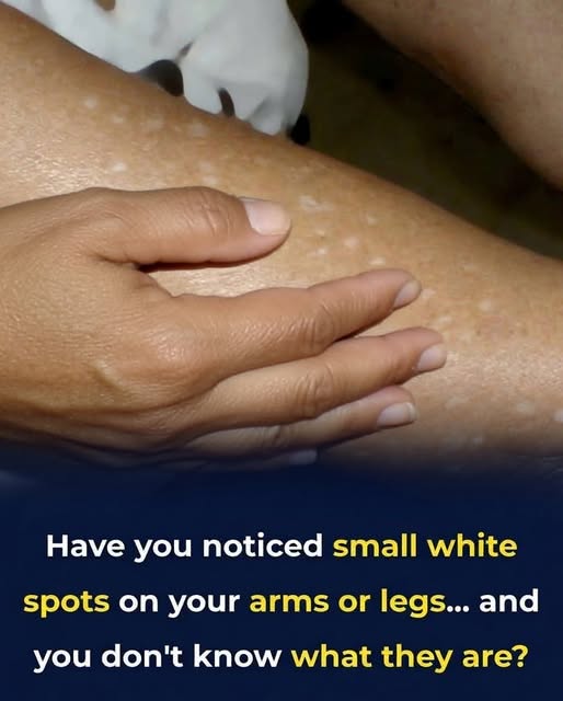 What Vitamin Deficiencies May Lead to White Spots on the Skin