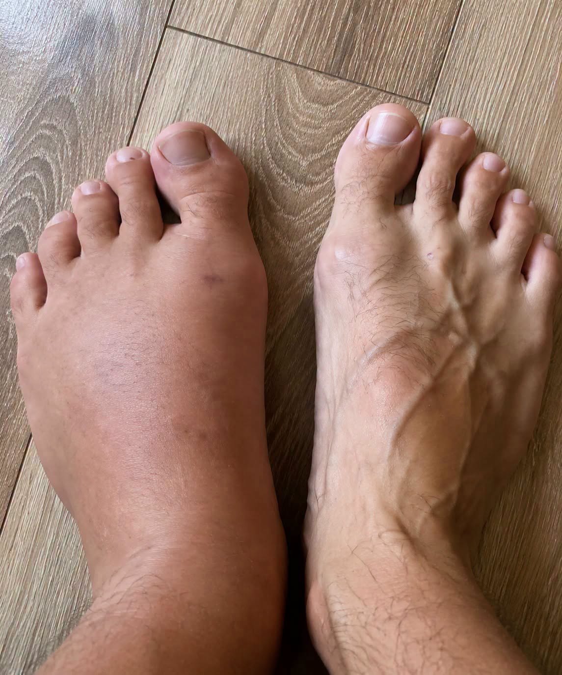 Swollen Feet and Ankles: Common Causes, Simple Care Tips, and When to Seek Advice