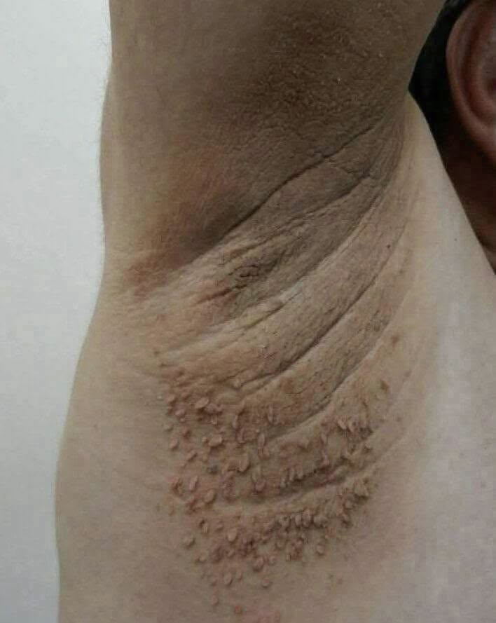 What Dark Patches on the Neck May Be Telling You About Your Health