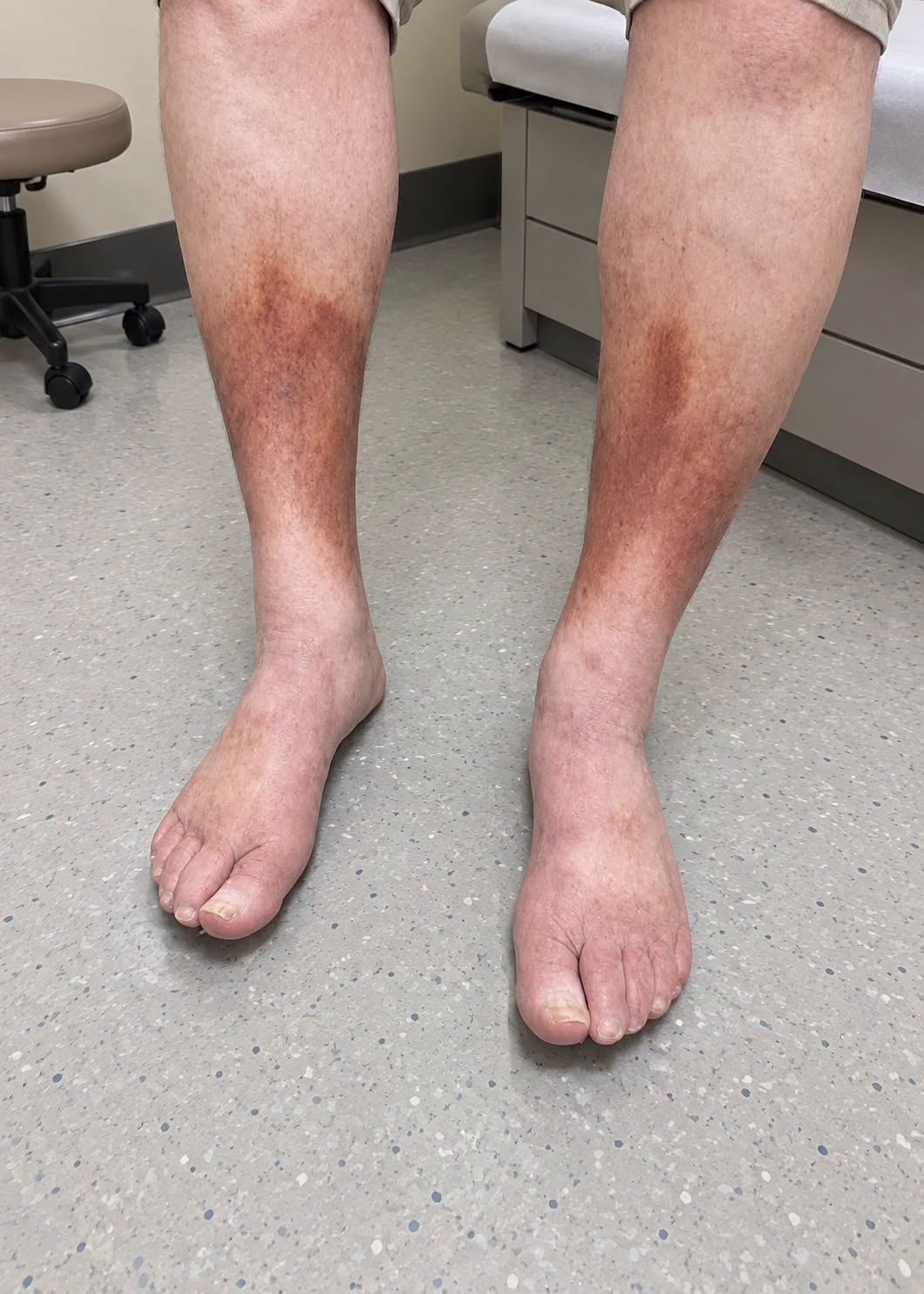 Persistent Leg Swelling and Skin Changes: Signs You Shouldn’t Ignore