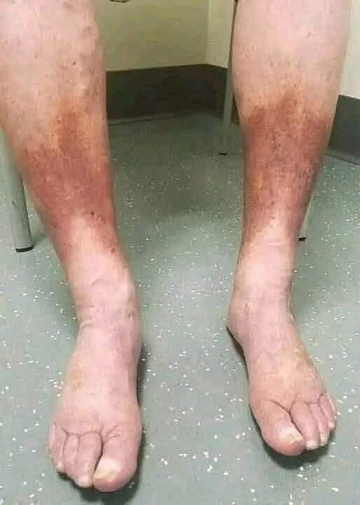 Swollen Ankles and Skin Changes: When These Symptoms May Need Medical Attention